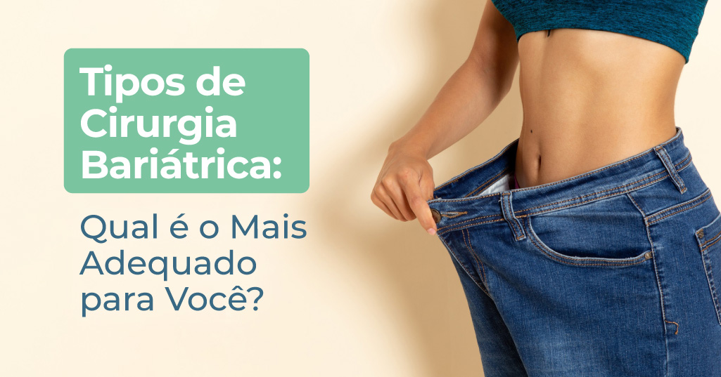 Tipos de Cirurgia Bariátrica: Qual é o Mais Adequado para Você?